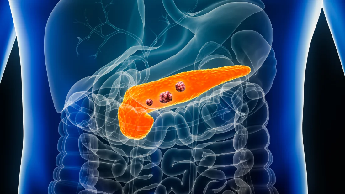 Pancreatic