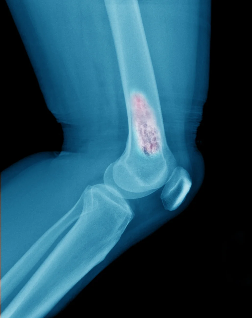 Sarcoma Bone